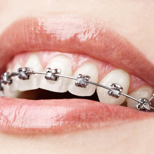 Sonrisa de mujer con brackets metálicos para tratamiento de ortodoncia en Bucaramanga