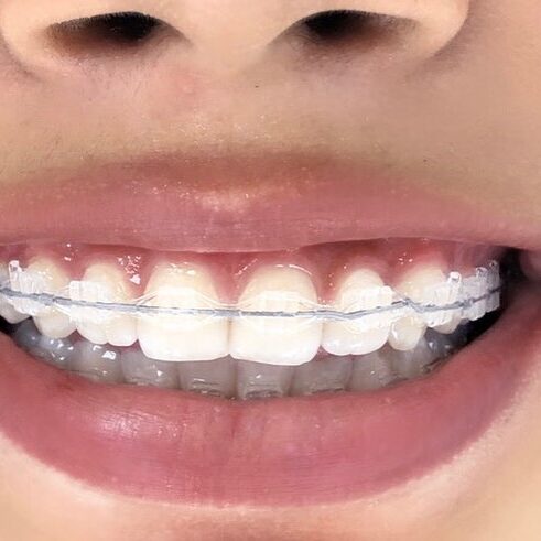 imagen ortodoncia estetica